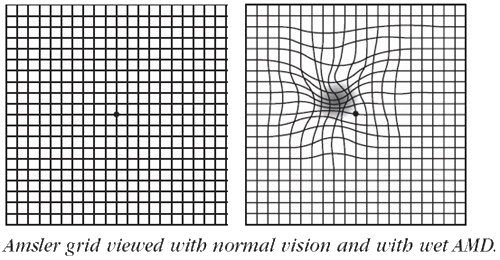 What is Age-Related Macular Degeneration or AMD?