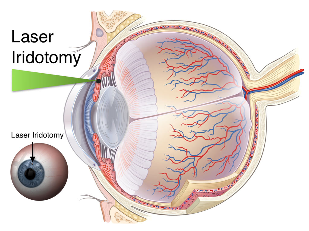 glaucoma-treatment-fraser-eye-care-center