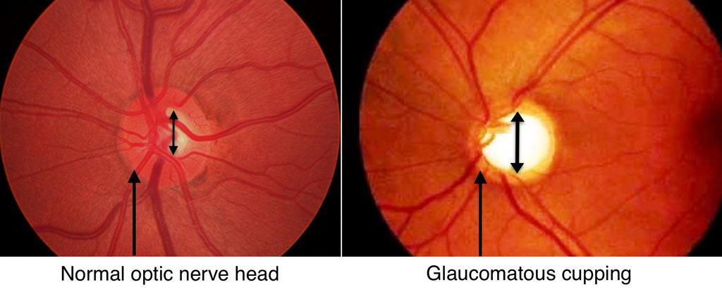 Optic Nerve Glaucoma Fraser Eye Care Center