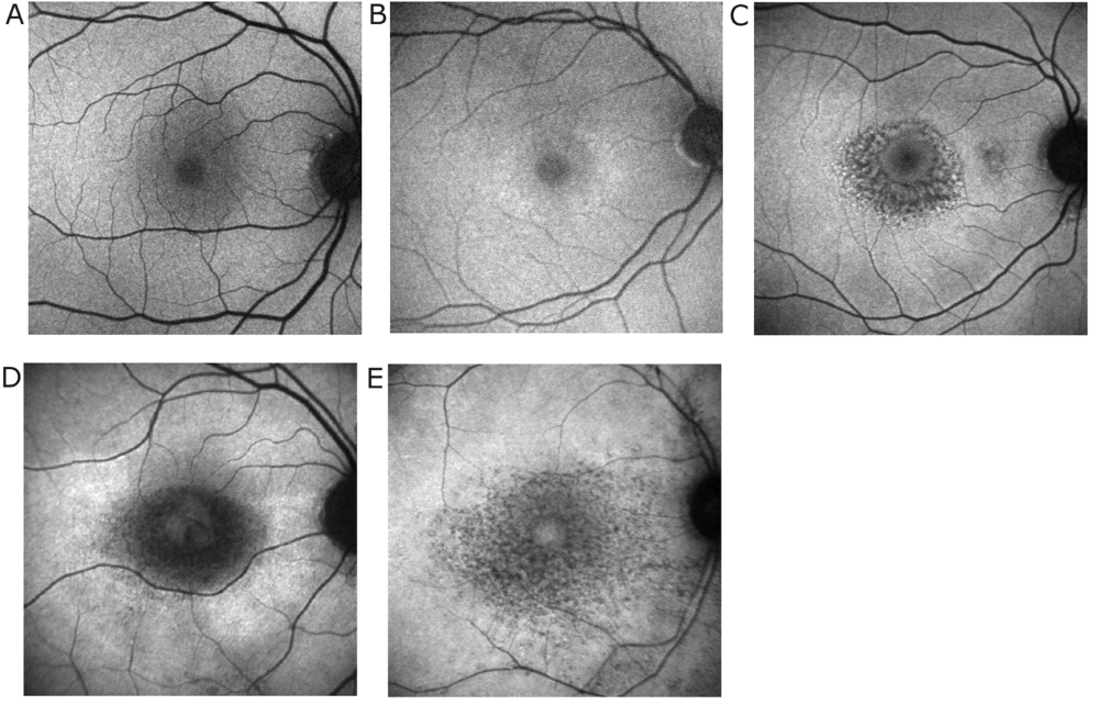 Plaquenil Related Eye Problems