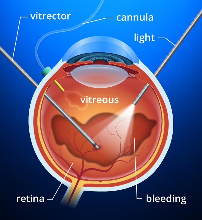 hole in retina surgery