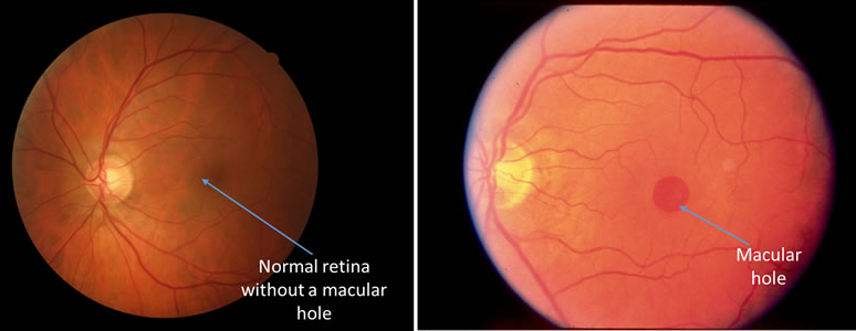 Macular Hole - Fraser Eye Care Center